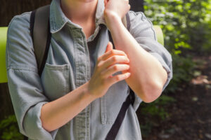 虫刺されで腫れがひどくなる原因とは？正しい対処法と治療法